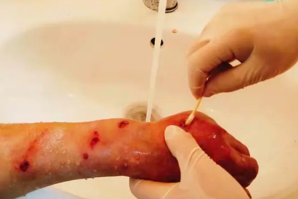 被一只马蜂蛰了有什么后果，被大型马蜂蛰到会很危险