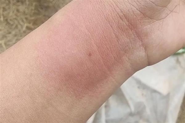被狗屎蜂蛰了有毒吗，狗屎蜂的毒性不强