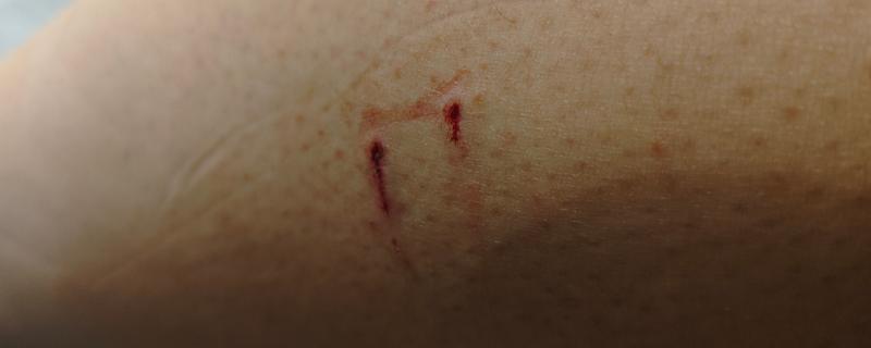 被猫抓伤出血要注射吗，如果抓伤严重需要去医院处理