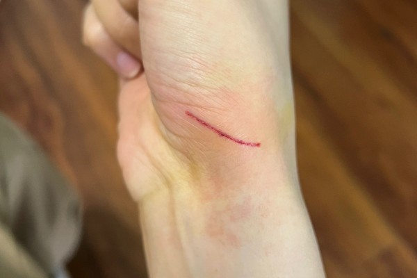 被猫抓伤出血要注射吗，如果抓伤严重需要去医院处理