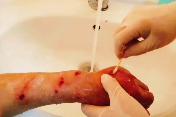 被猫抓伤出血要注射吗，如果抓伤严重需要去医院处理