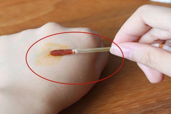 被猫抓伤出血要注射吗，如果抓伤严重需要去医院处理