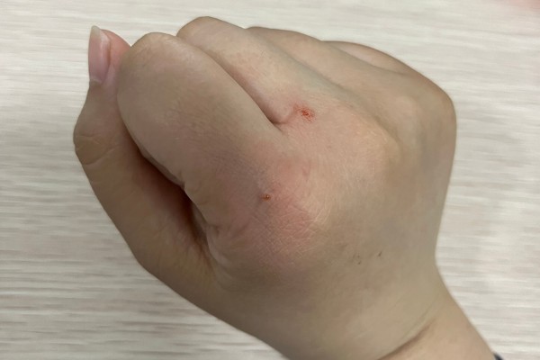 被猫抓伤出血要注射吗，如果抓伤严重需要去医院处理