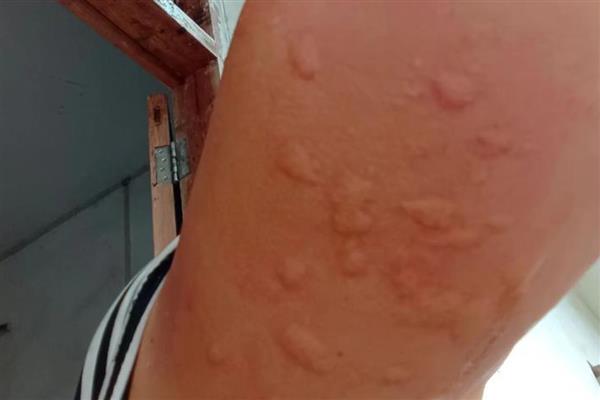 被毛辣子蛰到怎么处理,一定要及时取出毒毛