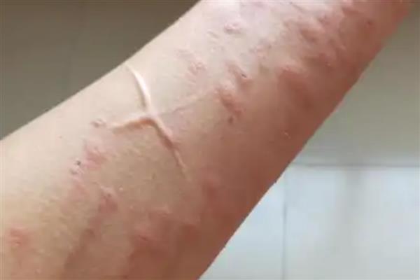 被毛辣子蛰到怎么处理,一定要及时取出毒毛