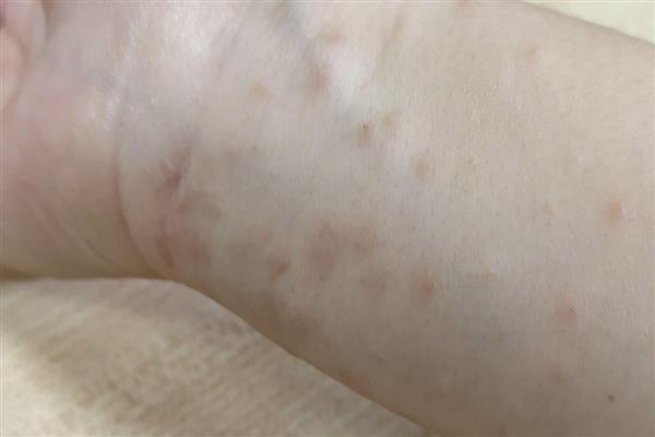 被毛辣子蛰到怎么处理,一定要及时取出毒毛